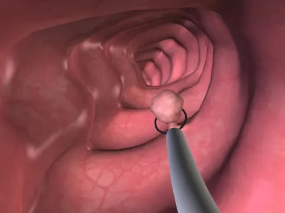 Colonoscopy