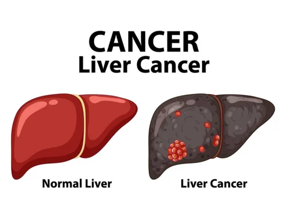 Liver Biopsy